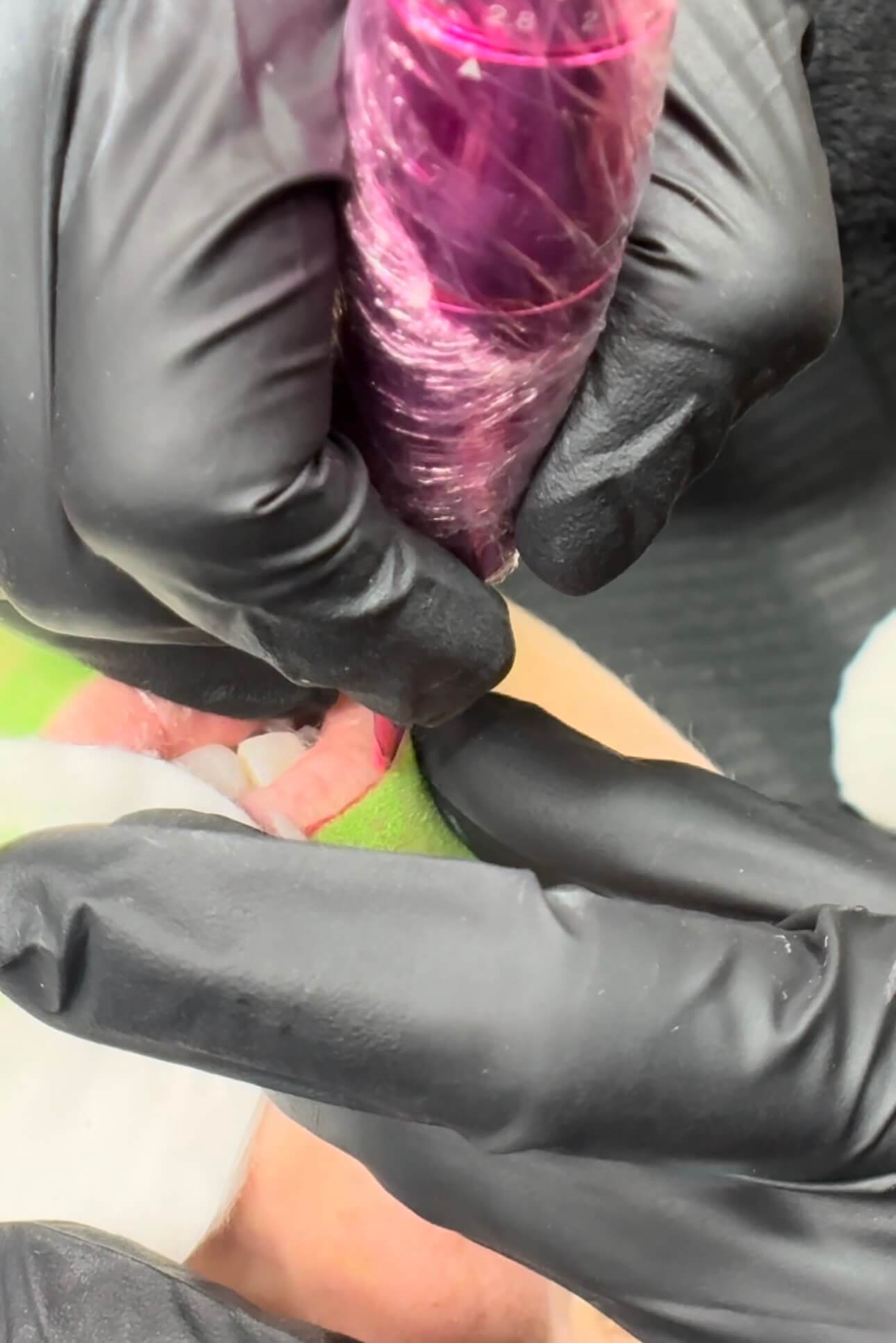 Diamond Lips Stage 2