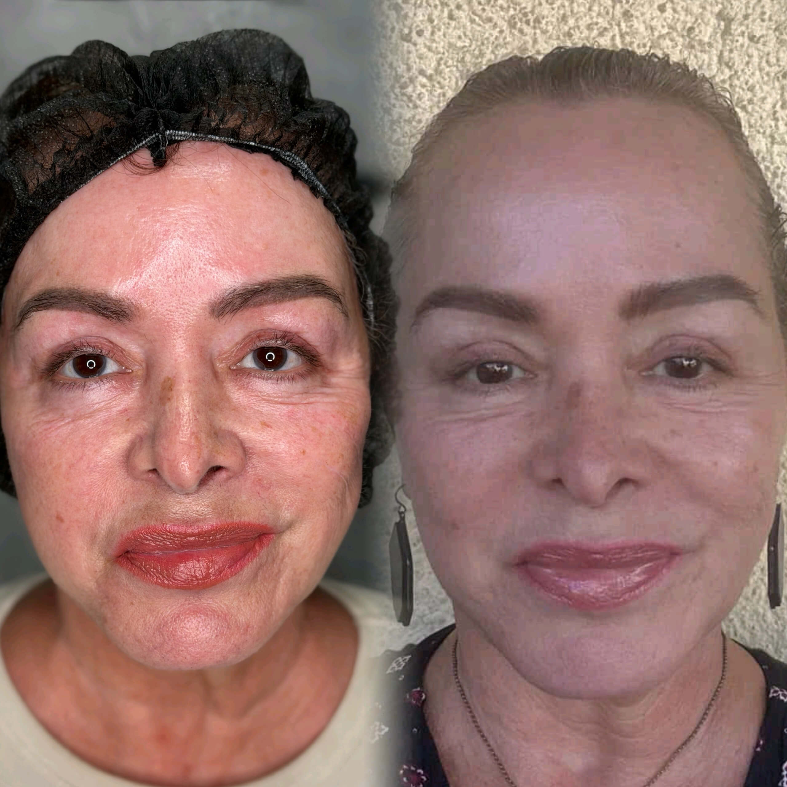 Skin Resurfacing Before After